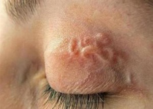Toxocariasis-